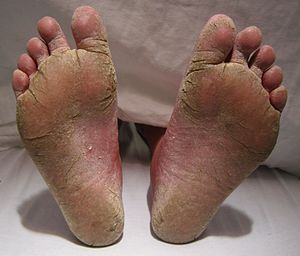Feet fungal infection